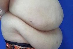 Cắt 6,5 kg da và mỡ giúp người phụ nữ béo phì lấy lại vóc dáng