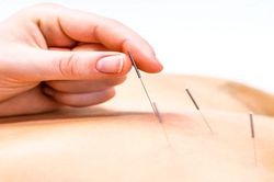 Điều trị rối loạn giấc ngủ bằng châm cứu