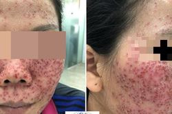Hiểm họa làm đẹp bằng sản phẩm lột da