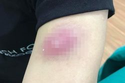 Tiền mất, tật mang vì tiêm tan mỡ ở spa
