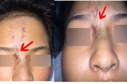 Bé 13 tuổi mất thị lực do tiêm filler thẩm mỹ