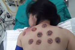 Phải nhập viện phẫu thuật sau khi giác hơi