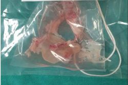 Phẫu thuật cứu bệnh nhân có ổ sán khổng lồ trong não