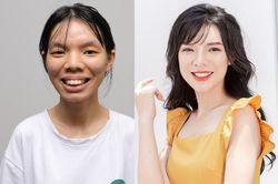 10X lột xác nhờ thẩm mỹ: 'Mình xấu nên chưa từng dám mở lòng yêu ai'