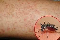 Nhiều biến chứng nguy hiểm do sốt xuất huyết