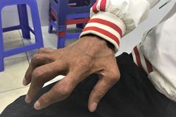 Dùng thuốc chữa vảy nến chứa corticoid, người đàn ông bị tàn phế