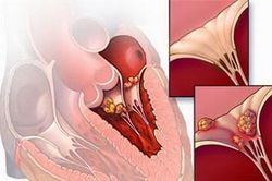 Viêm cơ tim vẫn có thể ngăn ngừa