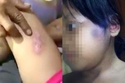 Bé gái 6 tuổi bị châm thuốc lá vào người
