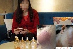 Hàng loạt chủ spa tố cơ sở làm đẹp tại Hà Nội bán mỹ phẩm trị nám mặt gây dị ứng, nổi mẩn đỏ nhiễm trùng da cho khách