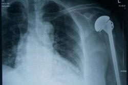 Những điều cần biết về phẫu thuật thay khớp vai
