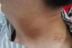 Bị đột quỵ cấp tính sau khi đi massage thư giãn, chuyên gia cảnh báo 6 dấu hiệu nguy hiểm