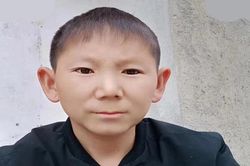 Chấn thương ở đầu khiến người đàn ông 34 tuổi trẻ mãi không già