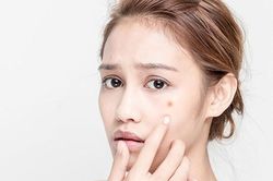 Những bí quyết 'vàng' để có một gương mặt sạch mụn