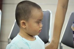 Bé trai 2 tuổi suýt mù mắt vì bị viêm xoang