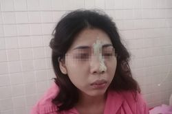 Mù mắt sau khi tiêm filler nâng mũi tại spa