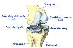 Đứt dây chằng chéo trước khớp gối