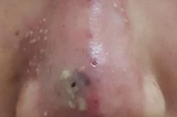 Một phụ nữ ngưng tim sau khi tiêm thuốc mê để nâng mũi