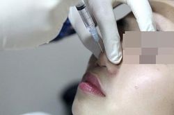 Vụ ngưng tim nghi do phẫu thuật nâng mũi: Bệnh nhân đã tỉnh