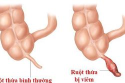 Nhận biết và xử lí bệnh viêm ruột thừa