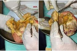 Đau bụng mãi không khỏi, đi khám người phụ nữ sửng sốt biết thứ nằm trong bụng suốt 15 năm