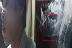 Tự ý sửa nhà trên đất tranh chấp, còn rủ người ném đá vỡ quai hàm hàng xóm