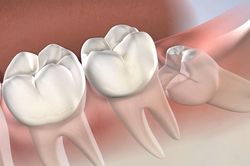 Tại sao con người có răng khôn?