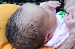 Bé sơ sinh phải khâu 6 mũi do bác sỹ sơ suất trong khi mổ