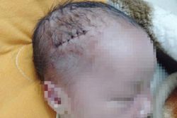 Bác sỹ làm rách đầu bé sơ sinh trong quá trình mổ đẻ