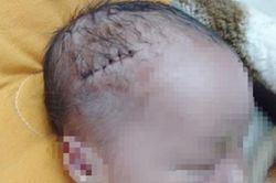 Mổ đẻ cho sản phụ, rạch trúng đầu cháu bé