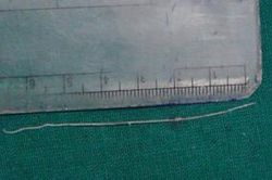Giun dài 7 cm sống ký sinh trong mắt bệnh nhân suốt 12 năm sau khi bị chó cắn