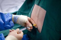 Không chỉ Đà Nẵng, nhiều địa phương cũng có sản phụ thiệt mạng sau khi gây tê tủy sống