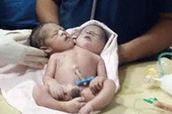 Siêu âm sinh đôi, sản phụ hốt hoảng khi đẻ ra bé trai 2 đầu 3 tay