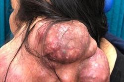 Bóc tách khối u khổng lồ ở cổ người phụ nữ