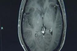 Ăn thịt lợn sống, một người Trung Quốc có tới hàng trăm con sán trong não