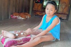 Ước mơ của cô bé Vân Kiều bị viêm xương và tủy