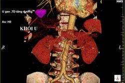 Thanh niên 28 tuổi mắc ung thư gan sau 10 năm nghiện rượu