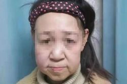 Thiếu nữ 15 tuổi bị gọi là 'quái vật' vì gương mặt như bà lão 60