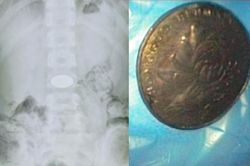 Trốn làm bài tập về nhà, cậu bé nuốt chửng đồng xu vào bụng