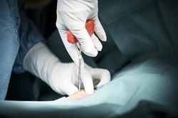 ADN và tinh trùng của người đàn ông bị biến đổi sau ca ghép tủy