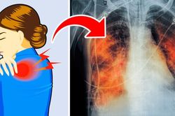 5 dấu hiệu của bệnh ung thư phổi nhiều người thường bỏ qua