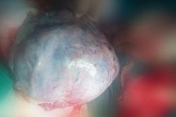 Phẫu thuật cắt bỏ u nang buồng trứng xoắn