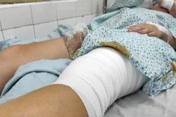 Nhập khẩu da người để điều trị cho nạn nhân bỏng