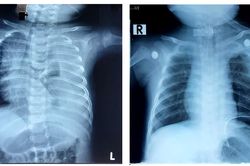Cứu sống bé trai 3 tháng bị rò dịch khoang màng phổi