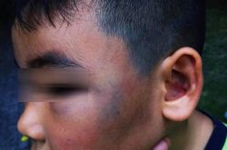 Bé 8 tuổi bị đánh bầm tím mặt vì nghịch đàn gà
