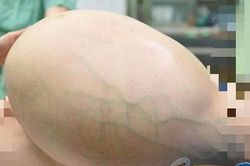 Bụng to như mang song thai vì khối u 35 kg trong buồng trứng
