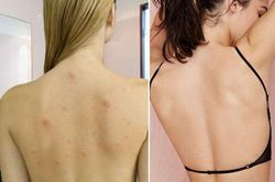 3 cách làm sạch mụn ở lưng vô cùng đơn giản