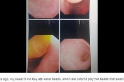 Con trai ăn gì nôn nấy, mẹ đưa đi khám thì choáng váng khi biết có thứ đồ chơi trẻ em này nằm trong ruột con