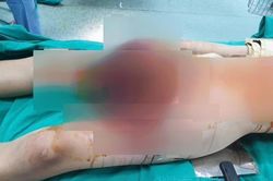 Chế pháo theo mạng xã hội, nam sinh 13 tuổi dập nát cánh tay