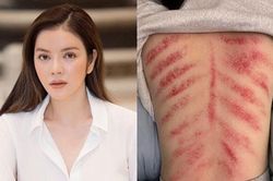 Lý Nhã Kỳ bất ngờ đăng tải ảnh tấm lưng đầy vết đỏ ửng kéo dài, bạn bè nghệ sĩ đồng loạt để lại bình luận lo lắng