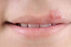 5 bất thường ở môi cảnh báo sức khỏe có vấn đề